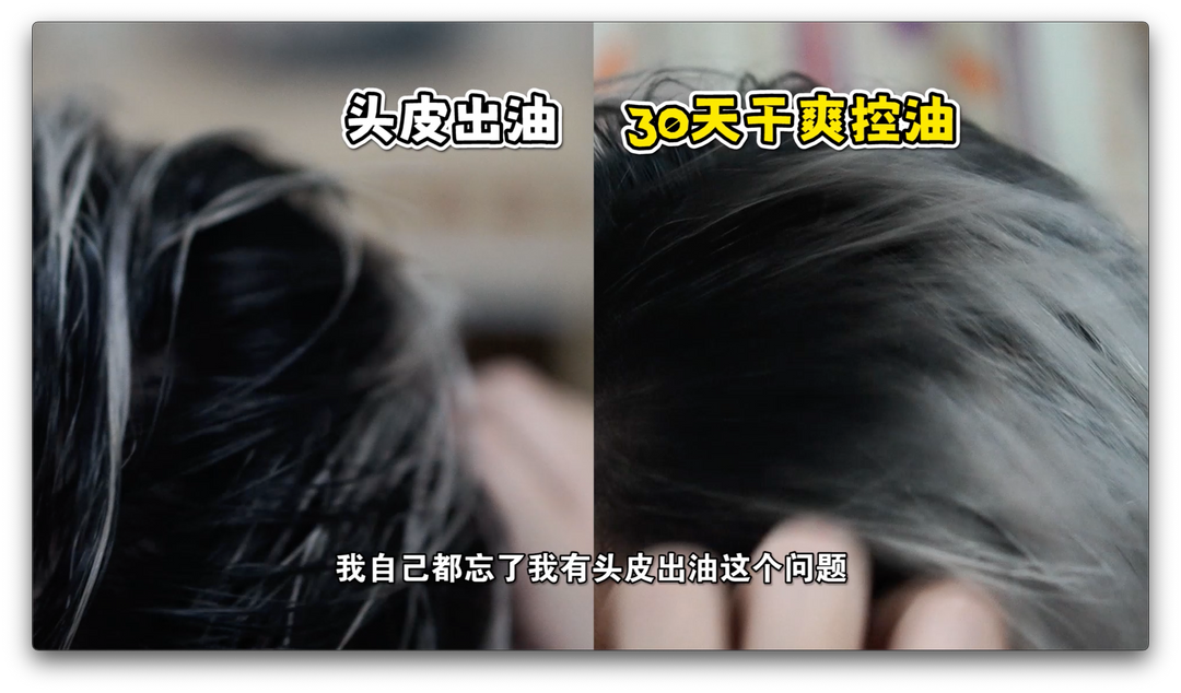 头皮容易出油 怎么办? What should I do if my scalp is prone to oiliness?