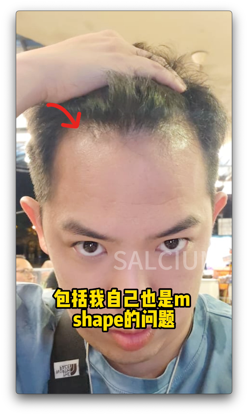 M shape 脱发怎么办? M shape hair loss