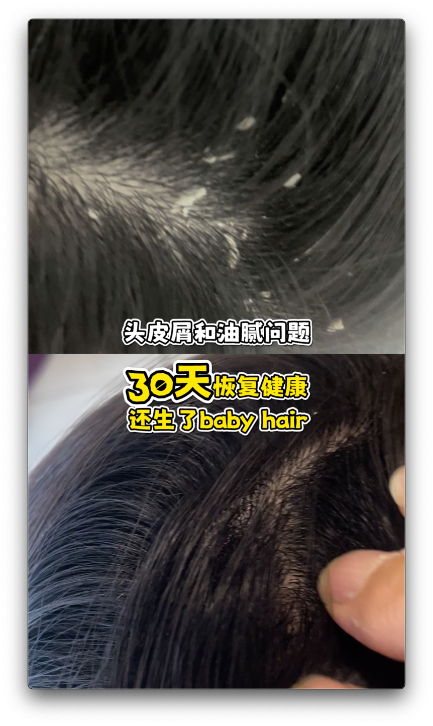 女生严重头皮屑 怎么办? What should girls do if they have severe dandruff?