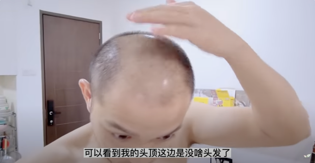 雄性秃的新疗法：Salcium逍可宣如何在120天内治愈8年的脱发？New Treatment for Male Alopecia: How Salcium Cures 8 Years of Hair Loss in 120 Days?
