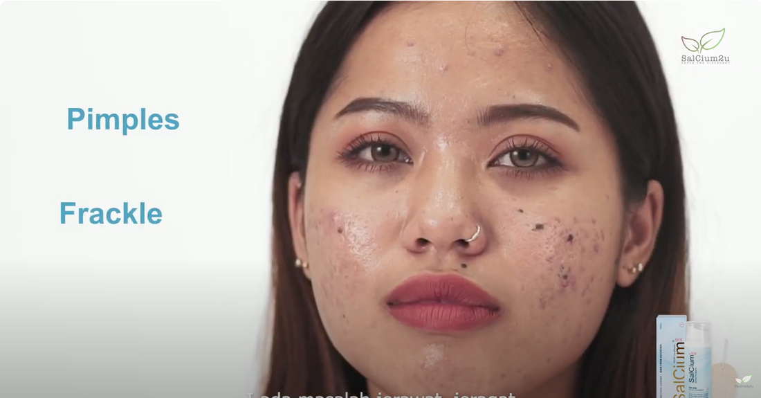 Alia成功解决痘痘问题，向Epi推荐SALCIUM® FRF Superoxide Dismutase Facial Cleanser