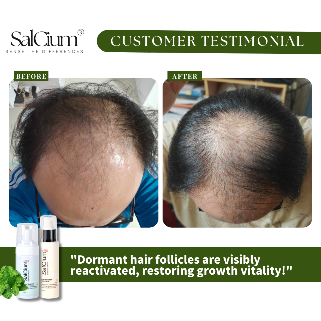 Hair Regrowth Success: How SalCium Revived Dormant Follicles!