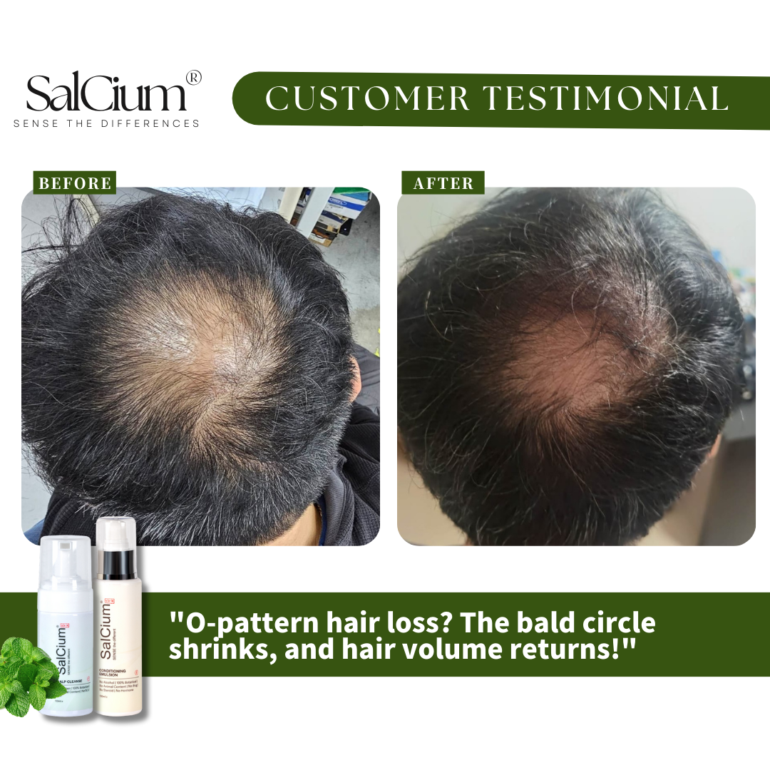 Reversing O-Pattern Hair Loss: A Remarkable Scalp Recovery Story