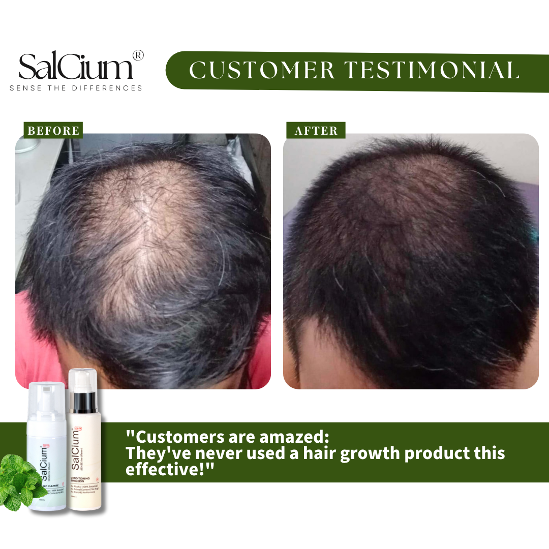 Reversing O-Pattern Hair Loss: A 90-Day Scalp Recovery Journey with Salcium®