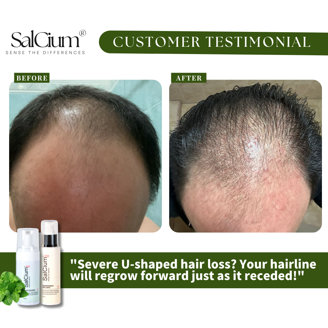 Reversing U-Shaped Hair Loss: A 90-Day Journey to a Fuller Hairline with Salcium®
