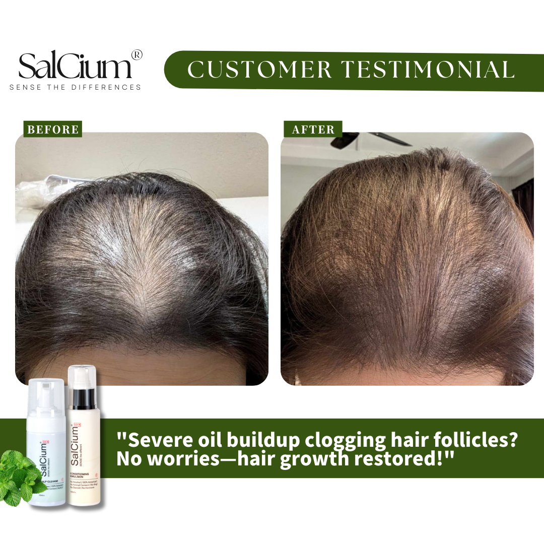 Overcoming Severe Oil Buildup: A 90-Day Journey to Restored Hair Growth with SalCium®