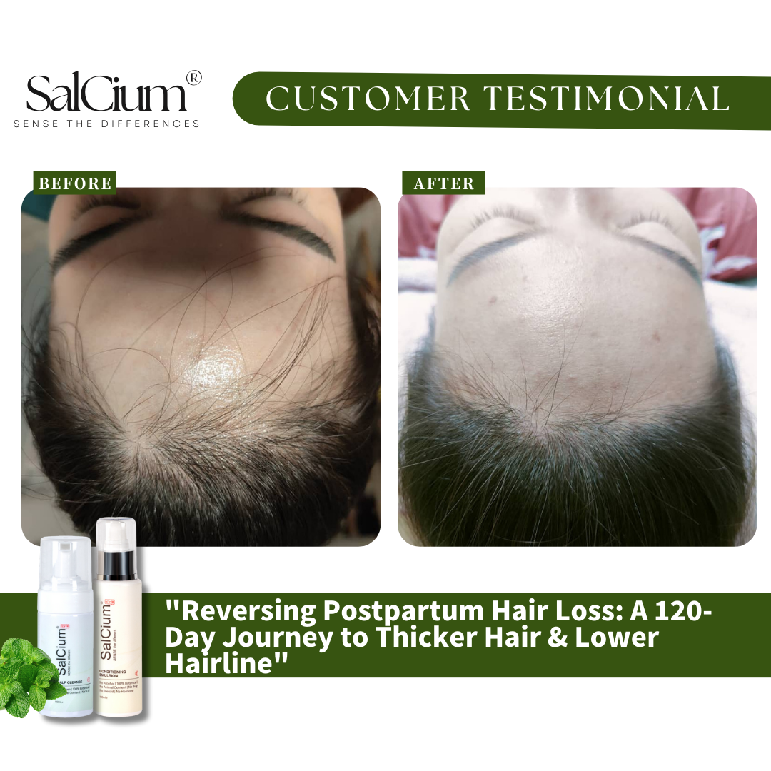 Reversing Postpartum Hair Loss: A 120-Day Journey to Thicker Hair & a Lower Hairline