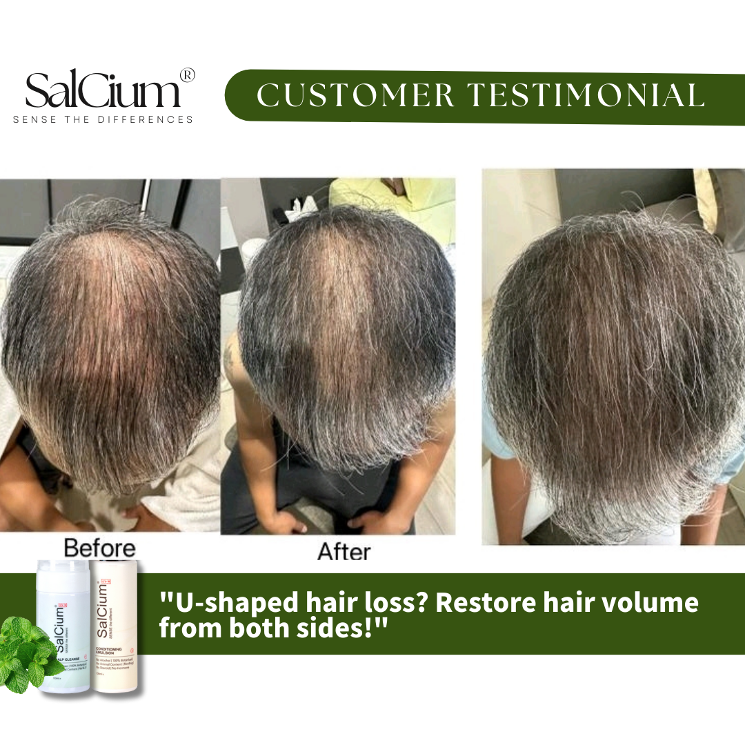 Reversing U-Shaped Hair Loss: A 90-Day Journey to Restored Volume with SalCium®