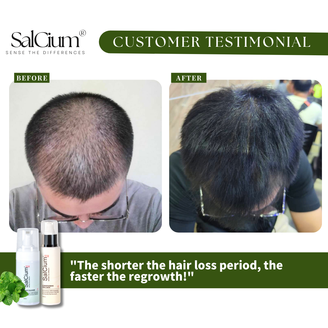 Fast Regrowth for Recent Hair Loss: A 90-Day Journey to Fuller Hair with SalCium®