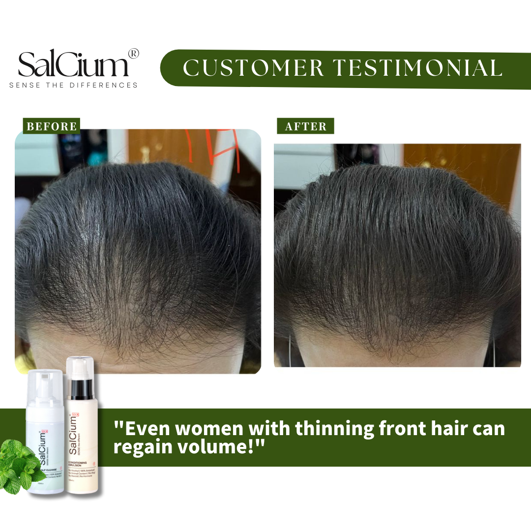 Restoring Volume to Thinning Front Hair: A 90-Day Journey for Women with SalCium®