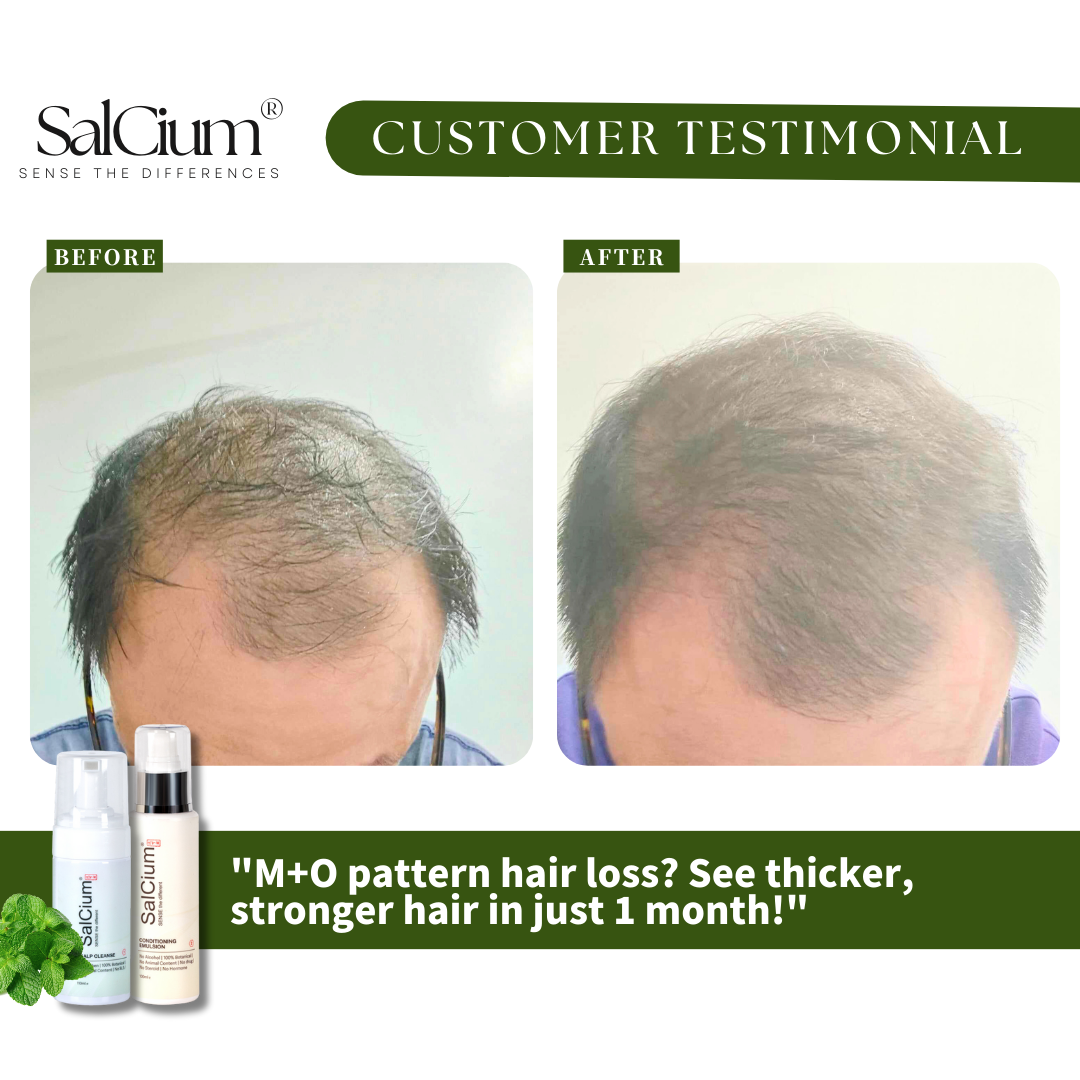 Tackling M+O Pattern Hair Loss: A 30-Day Journey to Thicker, Stronger Hair with SalCium®
