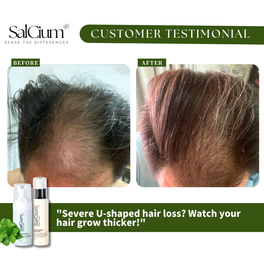 Overcoming Severe U-Shaped Hair Loss: A 180-Day Journey to Thicker Hair with SalCium®