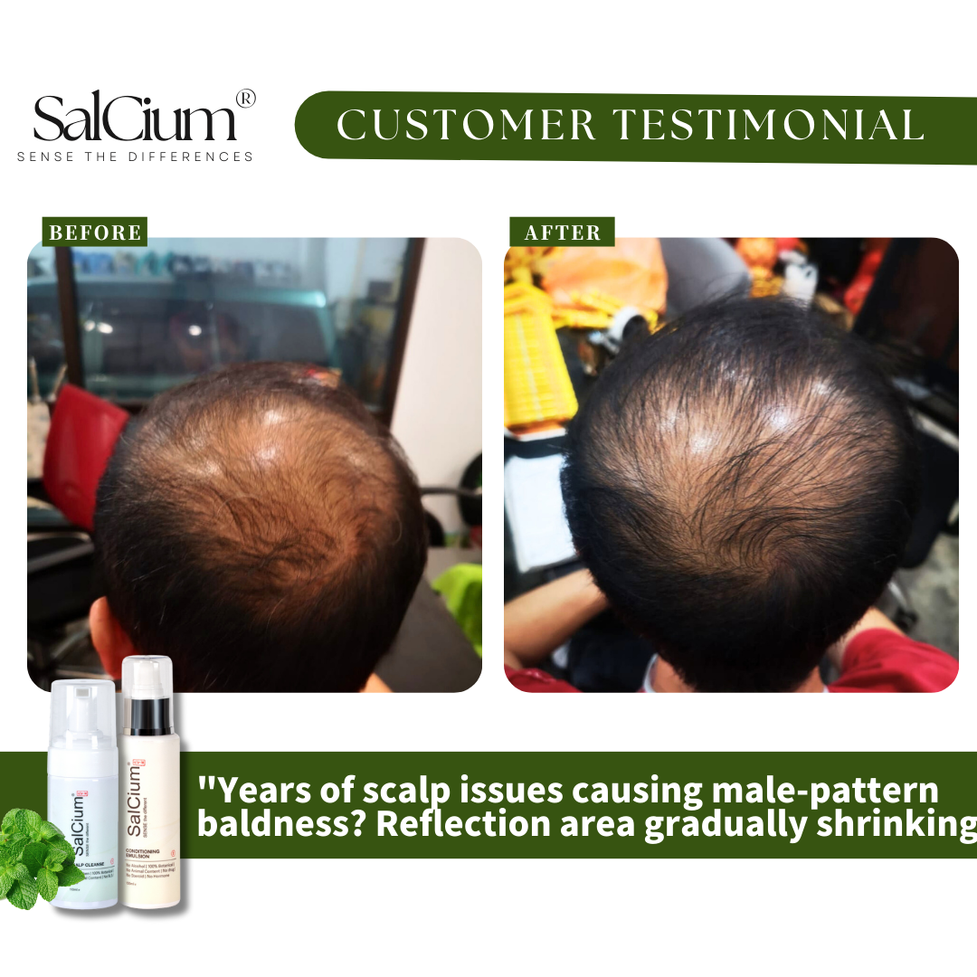 Reversing Years of Scalp Issues: A Journey to Restored Hair Density with SalCium®