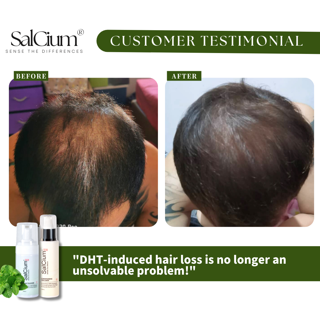 Conquering DHT-Induced Hair Loss: A 90-Day Journey to Fuller Hair with SalCium®