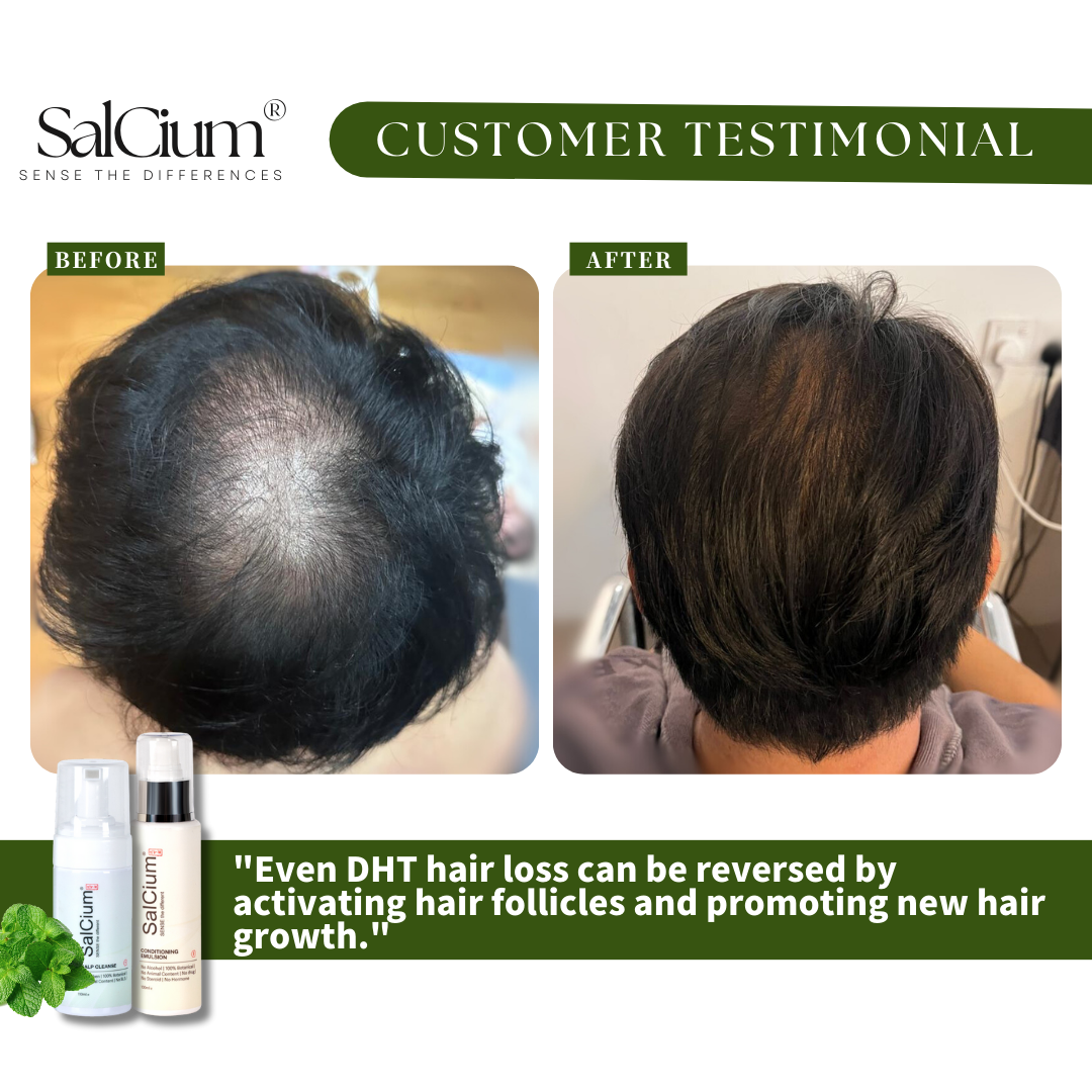 Reversing DHT-Induced Hair Loss: Alan’s Journey with SalCium