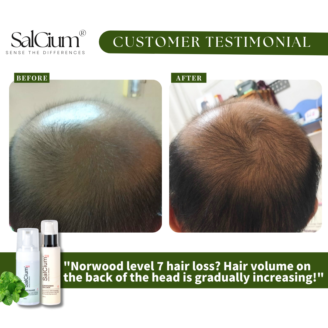 Tackling Norwood Level 7 Hair Loss: A 90-Day Journey to Increased Hair Volume with SalCium®