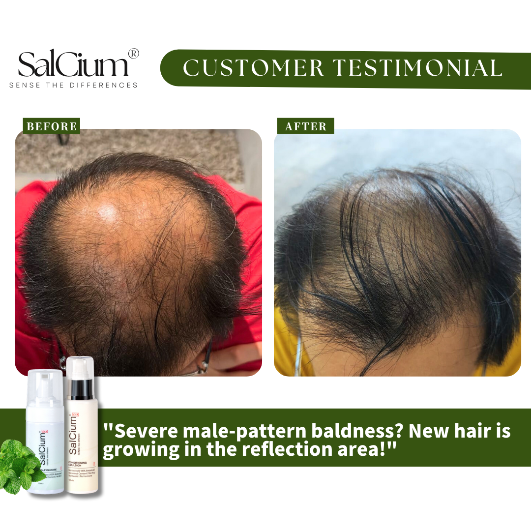 Overcoming Severe Male-Pattern Baldness: A 90-Day Journey to New Hair Growth with SalCium®