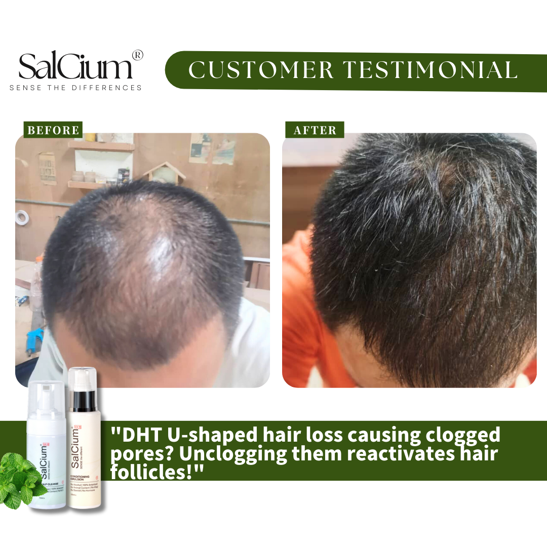 Reversing DHT U-Shaped Hair Loss: A 90-Day Journey to Reactivated Follicles with SalCium®