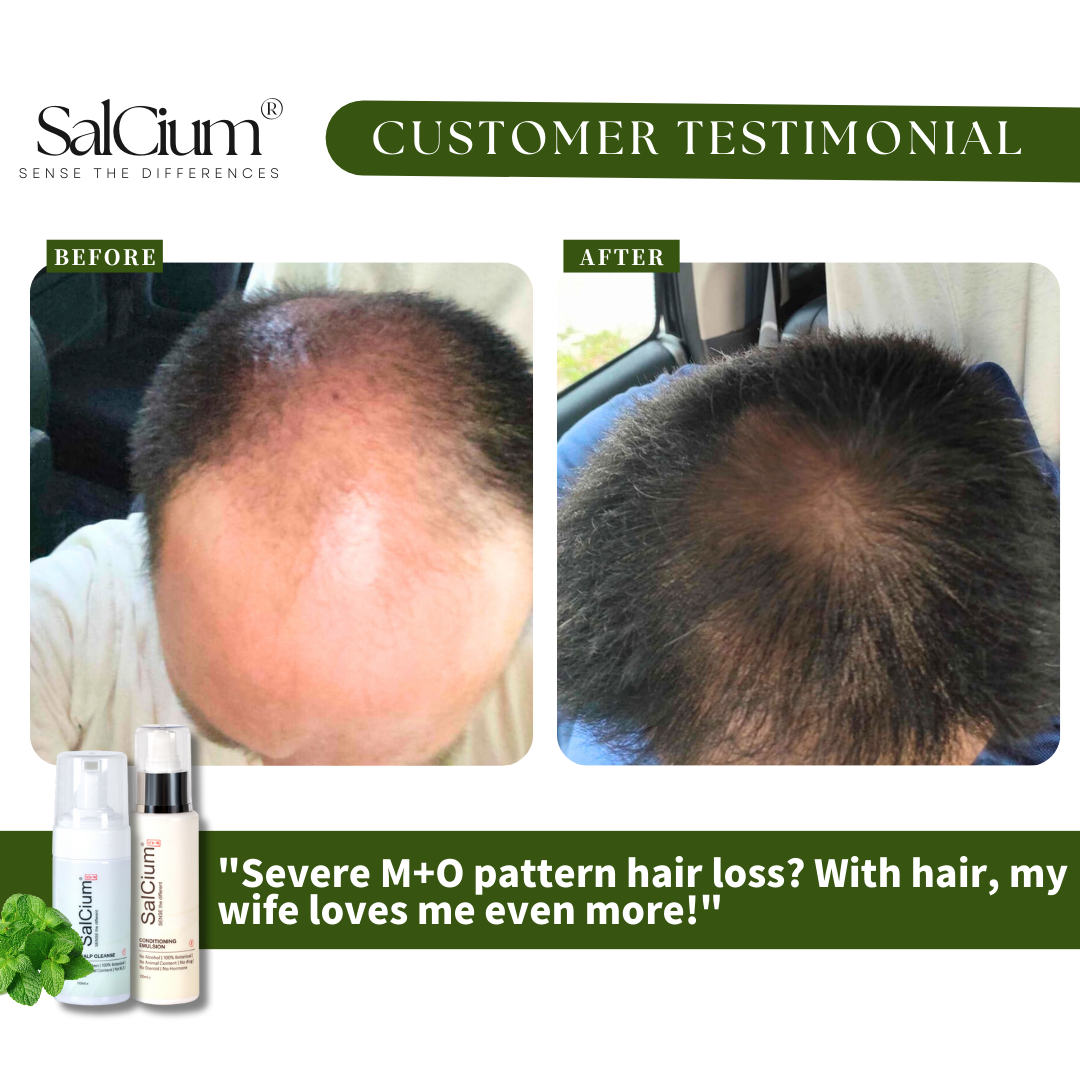 Reversing Severe M+O Pattern Hair Loss: A 90-Day Journey to Restored Confidence with SalCium®