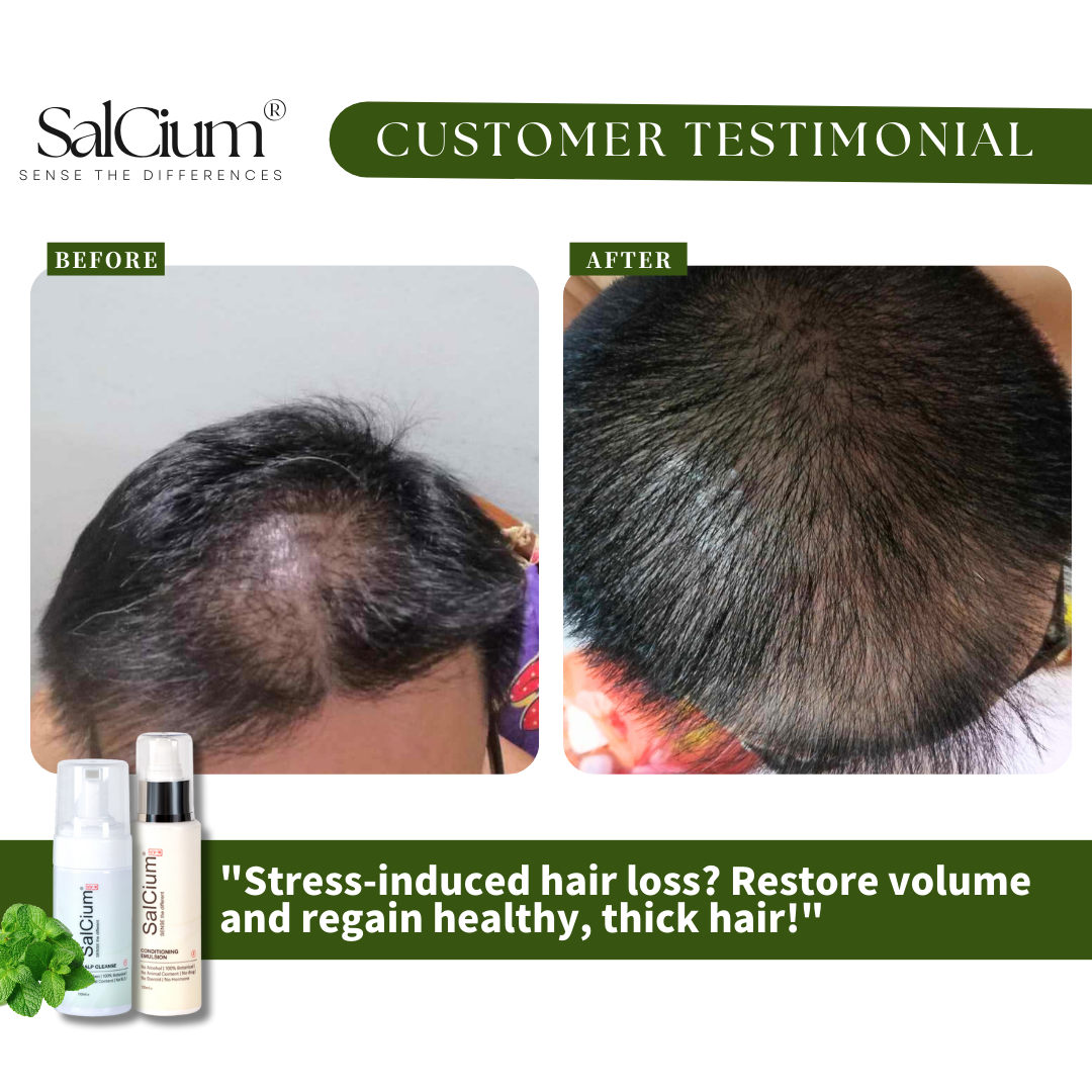 Overcoming Stress-Induced Hair Loss: A 90-Day Journey to Thicker Hair with SalCium®