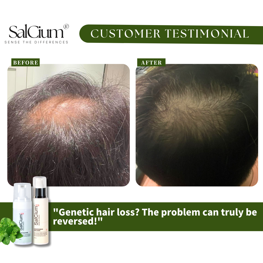 Reversing Genetic Hair Loss: A 90-Day Journey to Thicker Hair with SalCium®