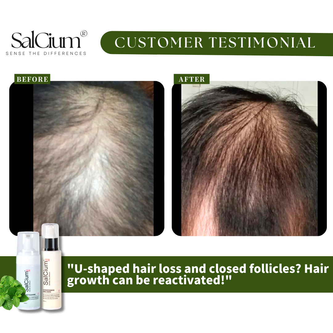 Reversing U-Shaped Hair Loss and Closed Follicles: A 90-Day Journey to New Growth with SalCium®
