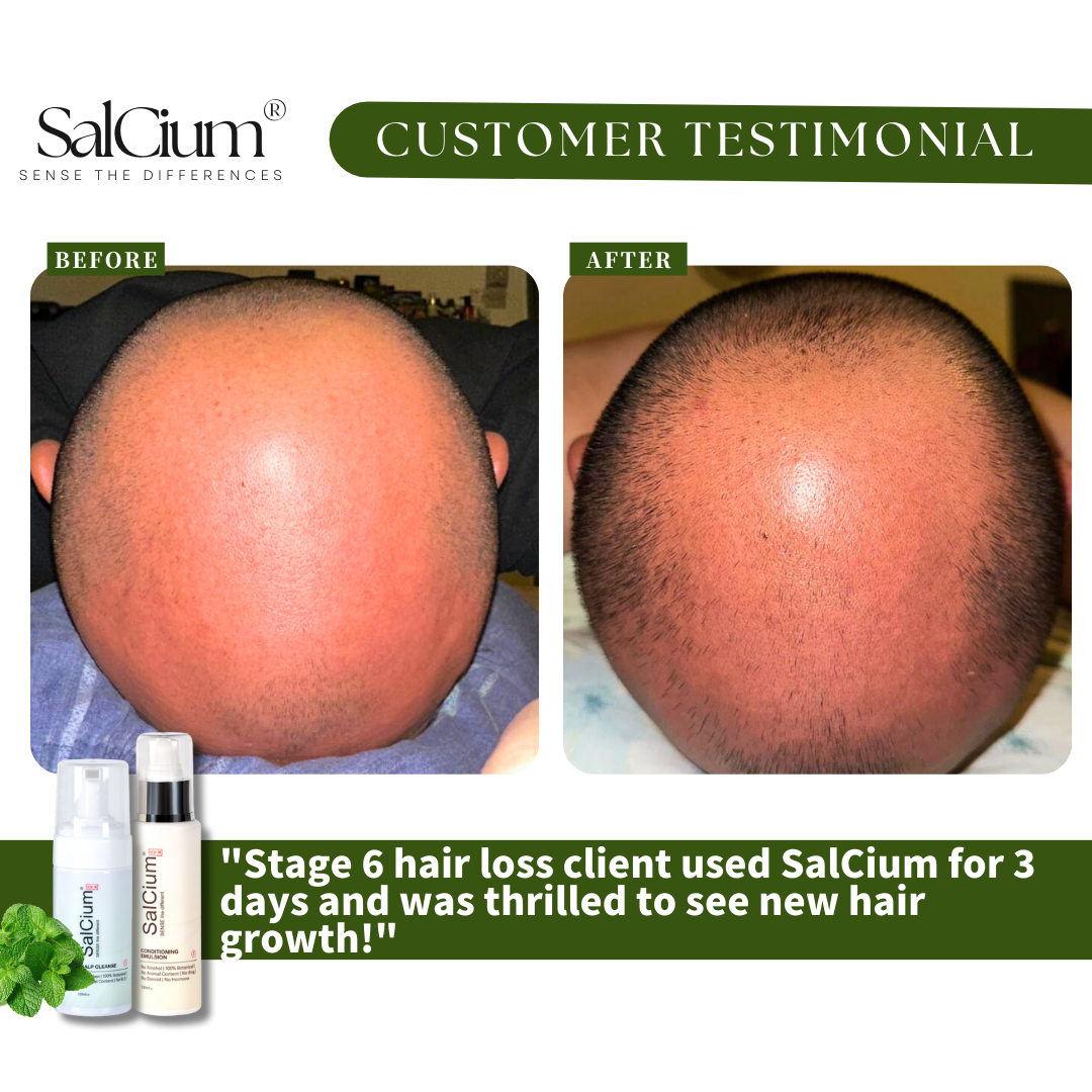 Stage 6 Hair Loss? See Visible Growth in Just 3 Days!