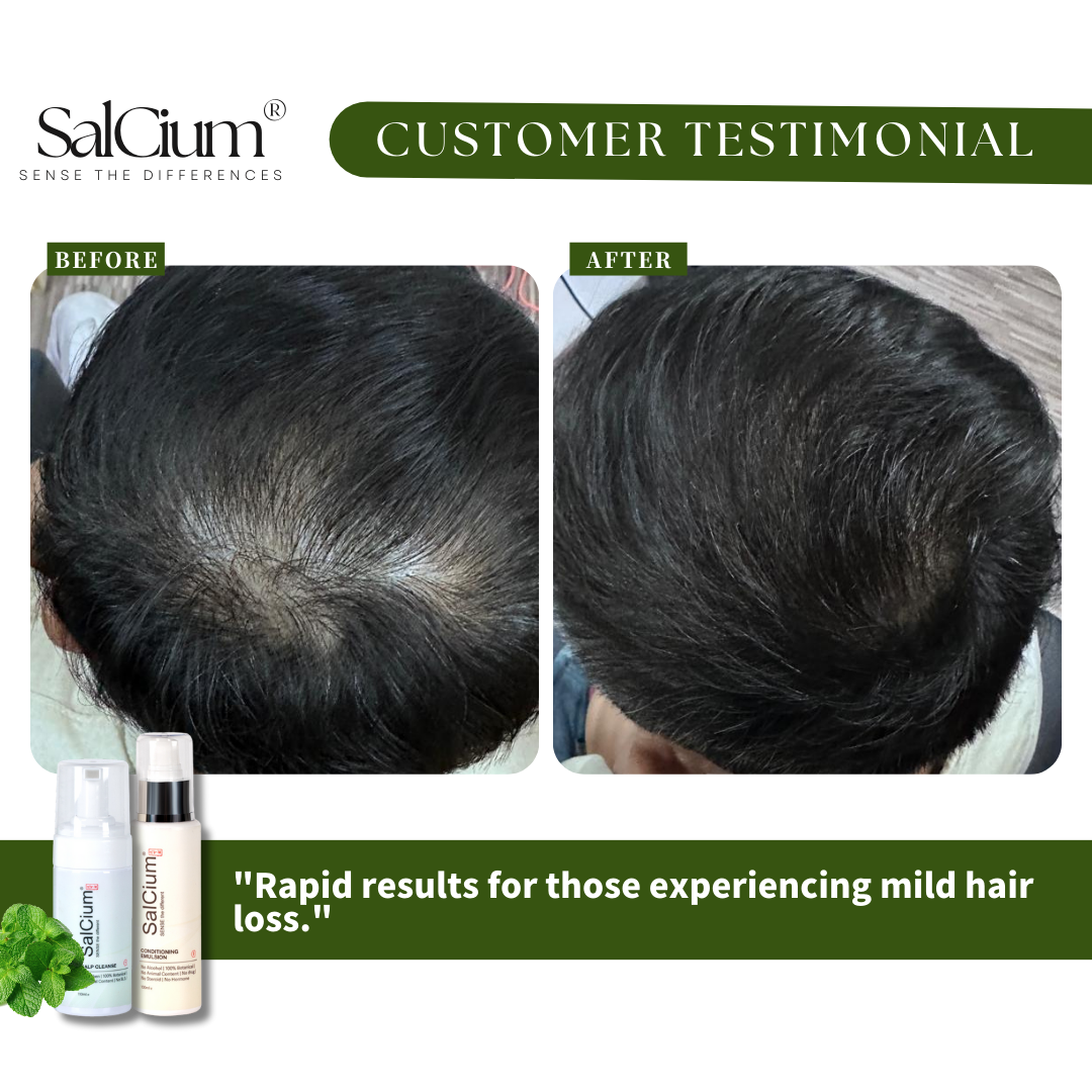 Reversing Genetic Hair Thinning: Alex’s Journey with SalCium