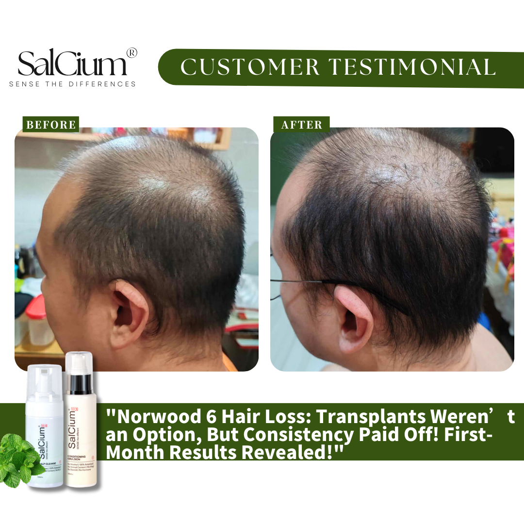 From Norwood 6 to New Hope: How SaiCium Delivered Results When Transplants Weren't an Option