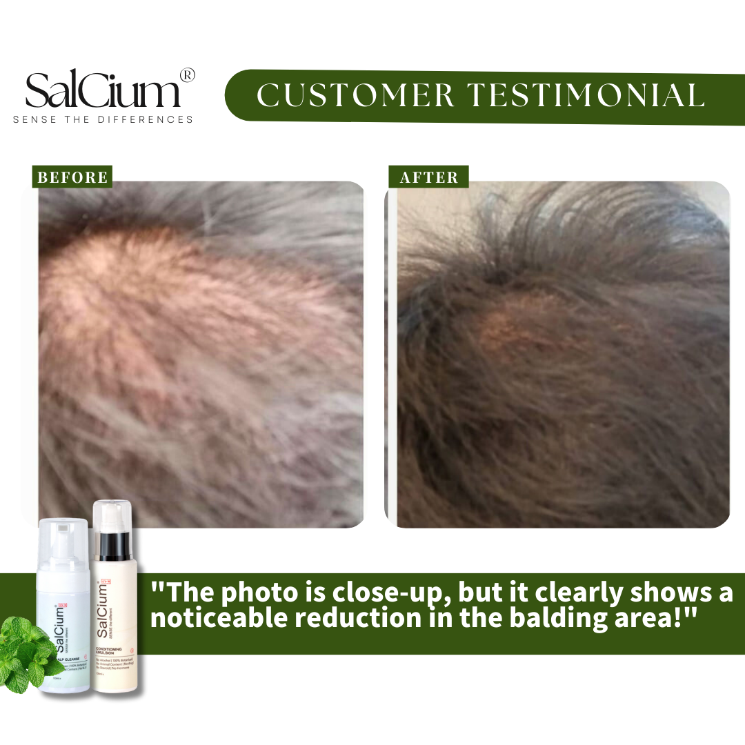 Close-Up Proof: How SaiCium Visibly Reduced Balding in Just 90 Days