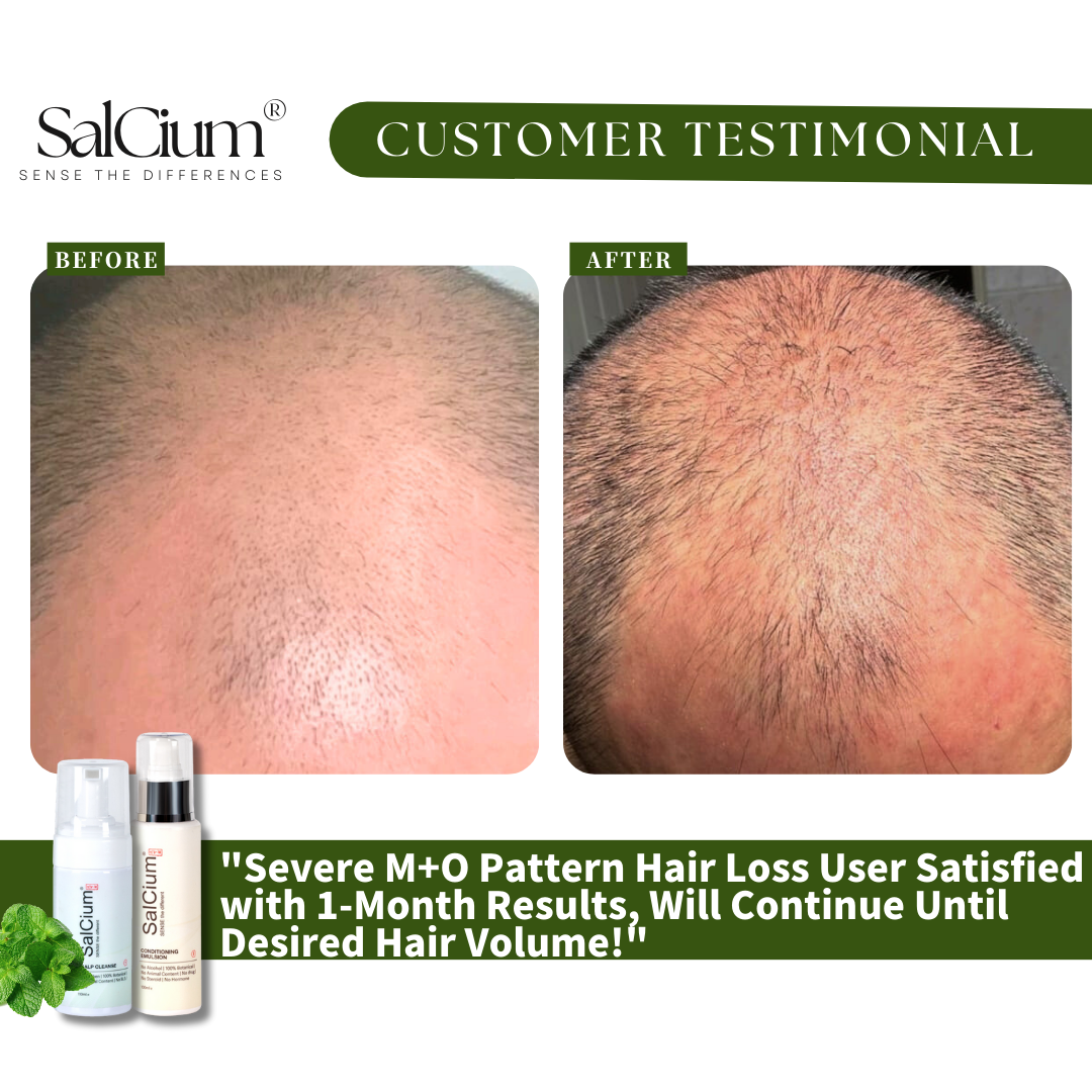Real Results for Male Pattern Hair Loss: A 1-Month Transformation with SalCium
