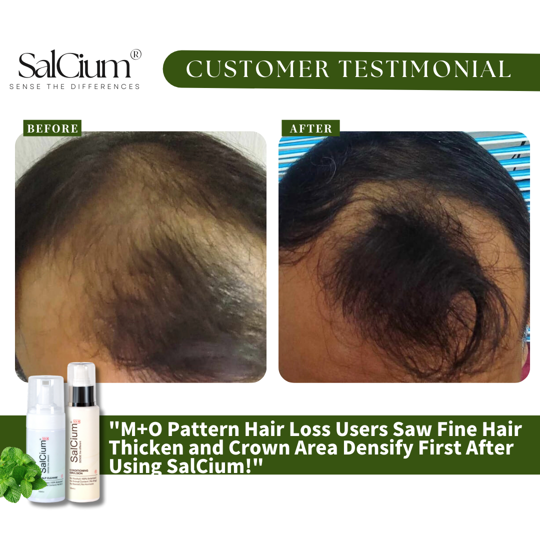 Breaking the Cycle of M+O Pattern Hair Loss – Real Results with SalCium!