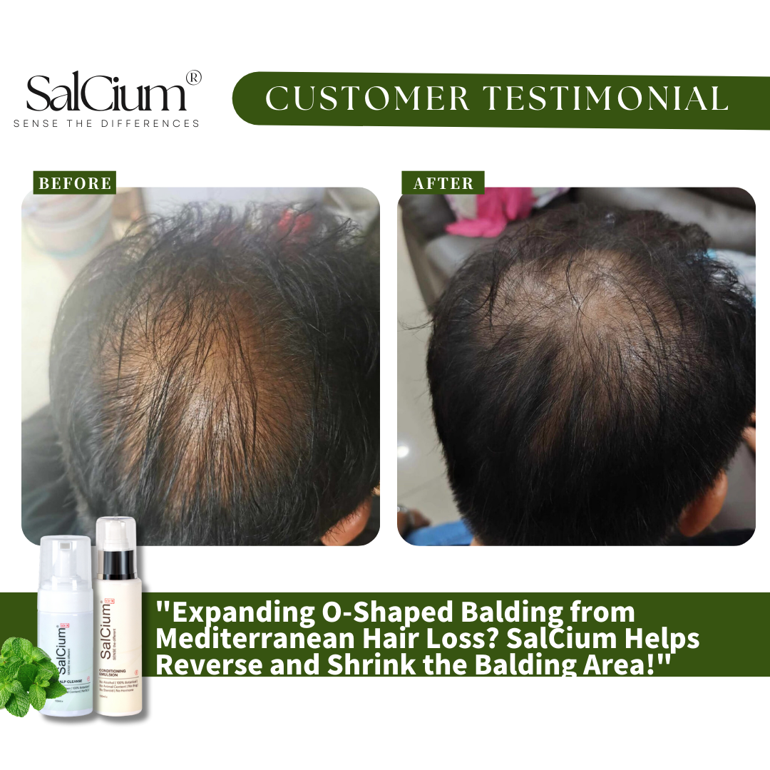 Reversing Mediterranean Hair Loss: How SaiCium Helped Shrink an Expanding O-Shaped Balding Area