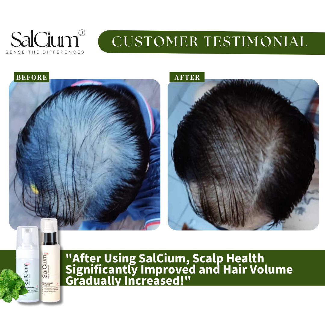 Reversing Male Pattern Thinning: How SalCium Improved My Hair Density