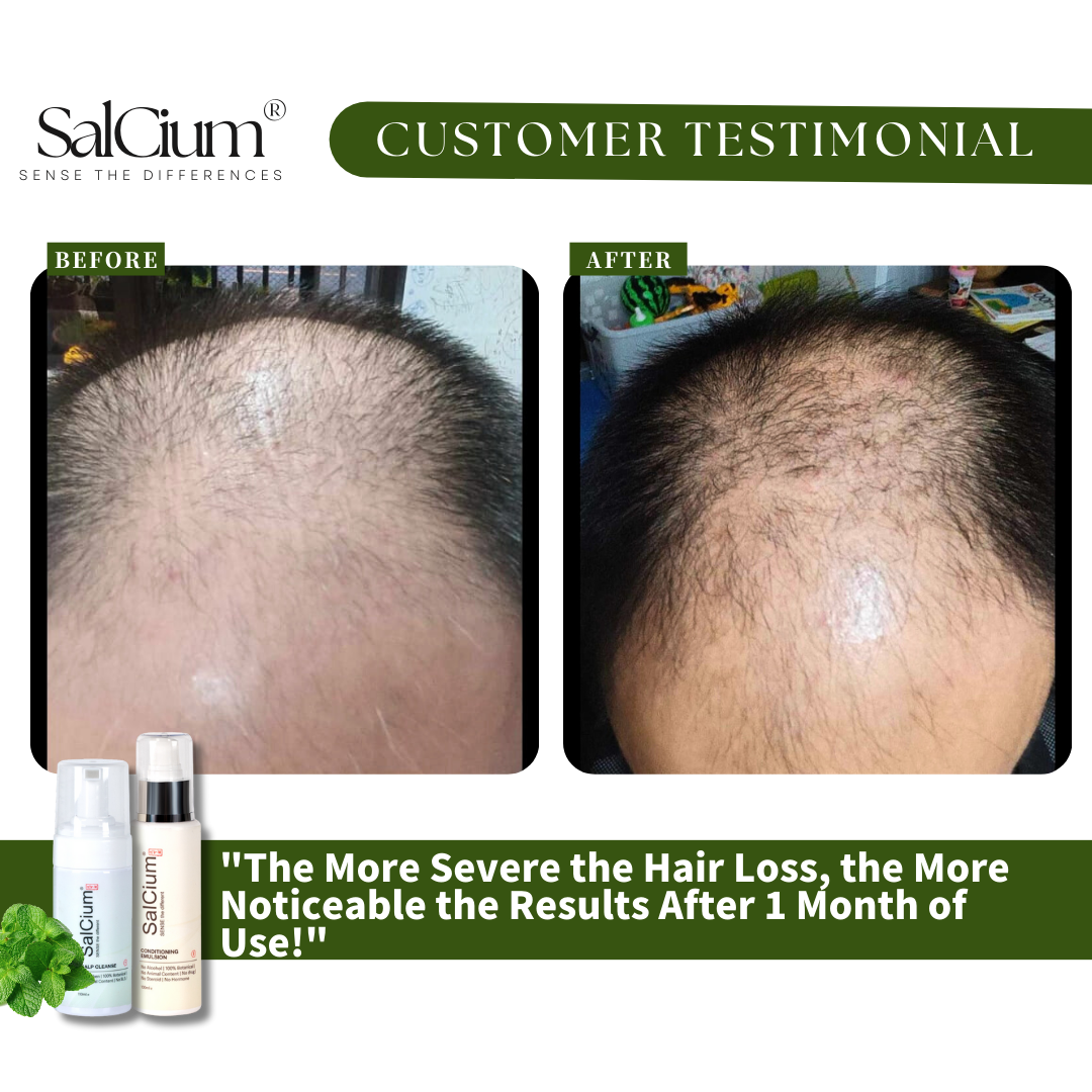 Defying Severe Hair Loss: Dramatic 1-Month Results with SaiCium