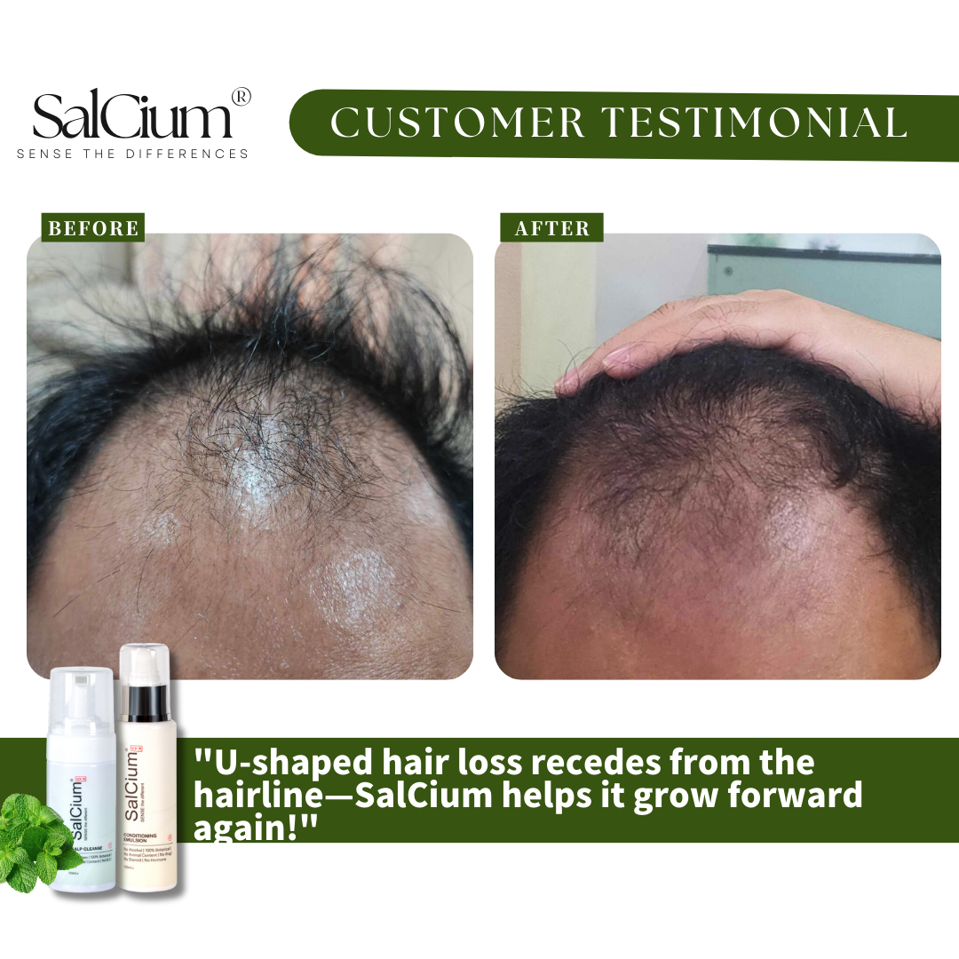 Professional Analysis: Reversing U-Shaped Hair Loss with SalCium