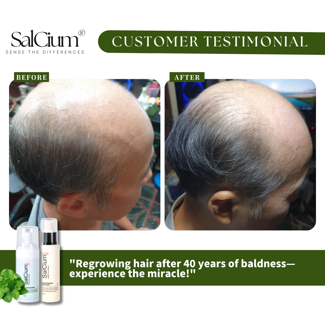 Regrowing Hair After 40 Years: Mr. Lee’s Transformation with SalCium