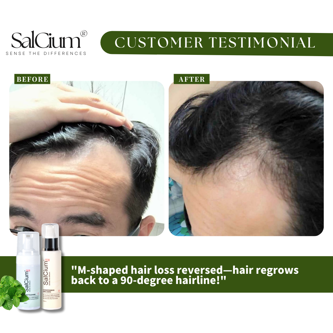 Restoring the Hairline: Alan’s Success with SalCium