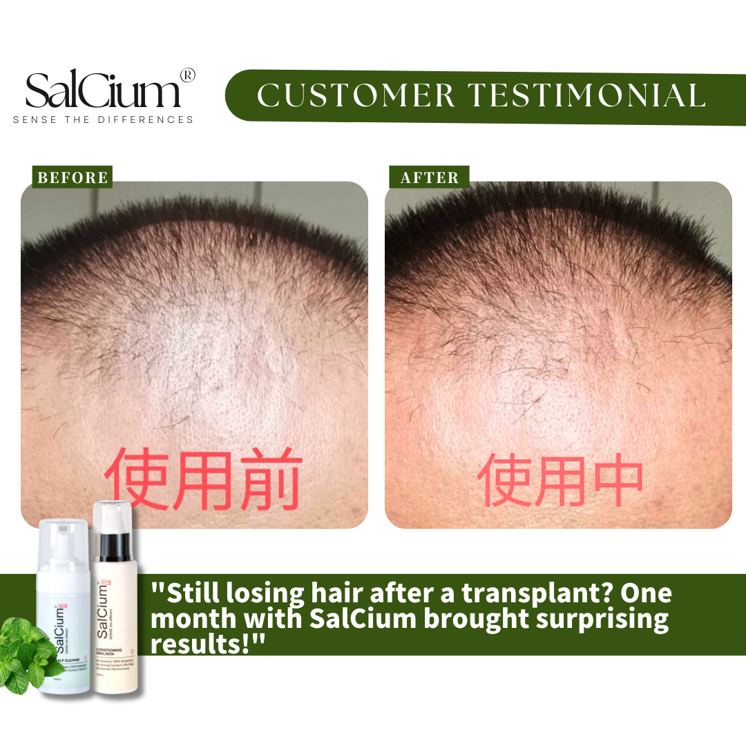 "My Hair Transplant Failed – Until I Tried This" – 1-Month Miracle with SalCium