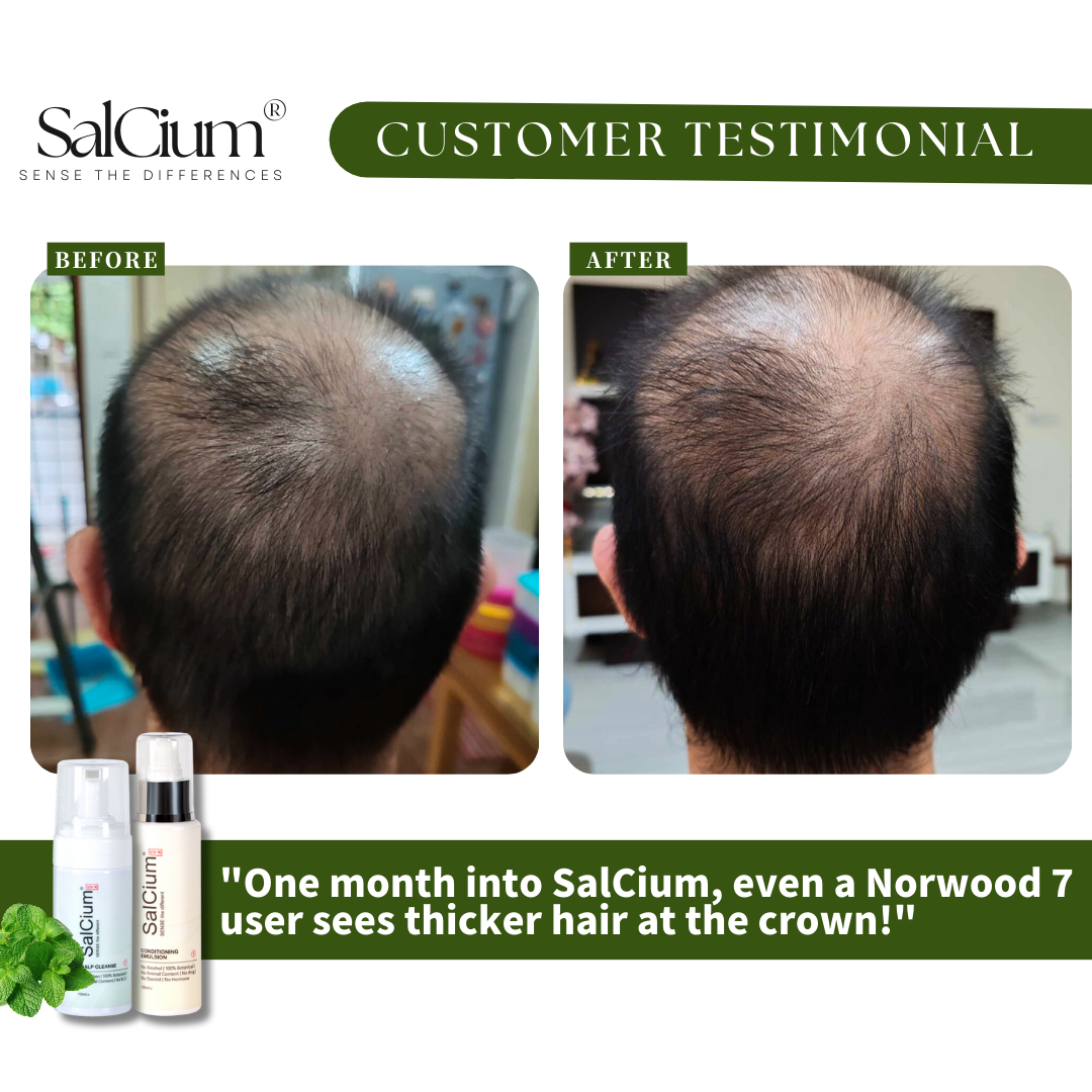 From Bald to Hopeful: A Norwood 7 Journey with SalCium