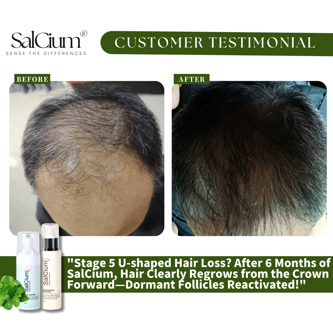 Can Stage 5 U-Shaped Hair Loss Be Reversed? This 6-Month Journey Says YES!