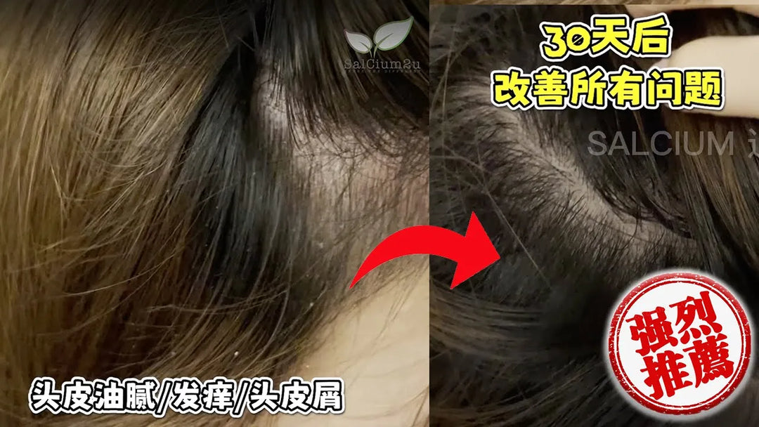 头皮屑 怎么办? What to do about dandruff