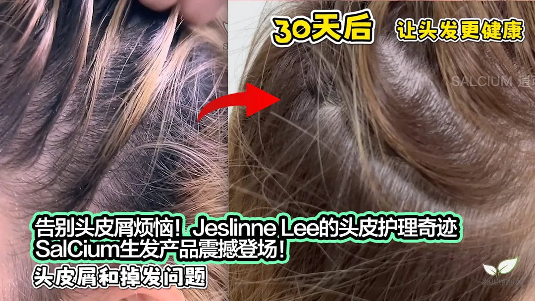 告别头皮屑烦恼！Jeslinne Lee的头皮护理奇迹，SalCium生发产品震撼登场！Say goodbye to dandruff worries! Jeslinne Lee's scalp care miracle, SalCium hair growth product is now available!