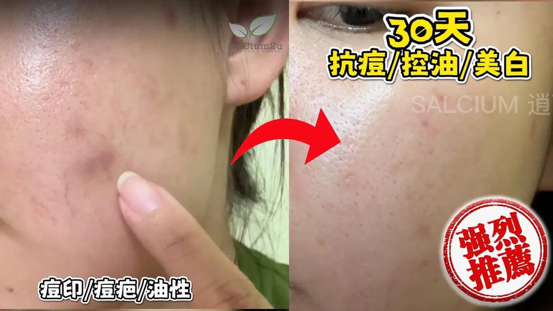 Xiu Yun的肌肤秘密揭晓！她是如何用逍可宣SalCium成功解决痘痘问题的？Xiu Yun’s skin secret revealed! How did she successfully solve her acne problem with SalCium?